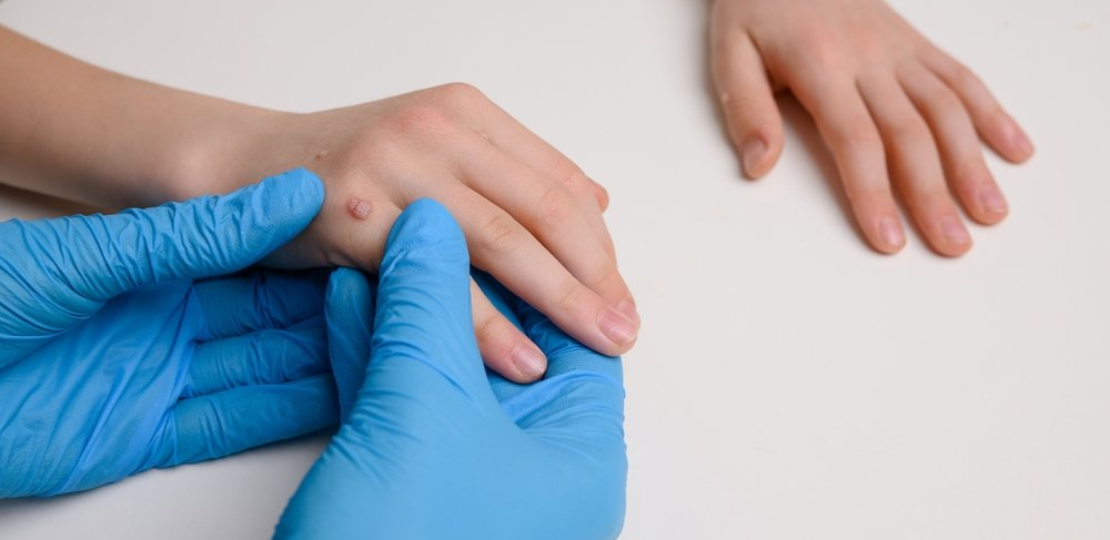 Odstranění bradavic