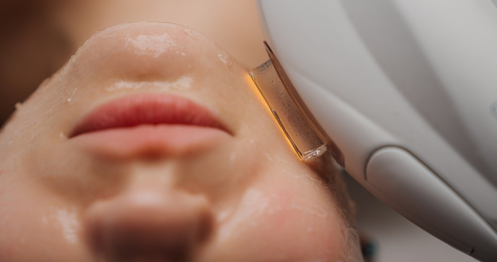 Fotorejuvenace Fotorejuvenace